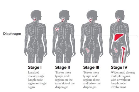 cbc test lymphoma|https://www.lls.org/lymphoma/hodgkin.